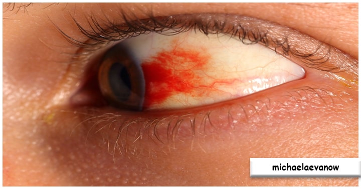 Retinopati Diabetik